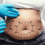 Can Abdominoplasty Improve Post-Baby Body Shape?